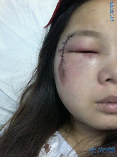 上面是楼主的照片,医生说,我的颧骨那里骨折了,以后消肿后,才能手术