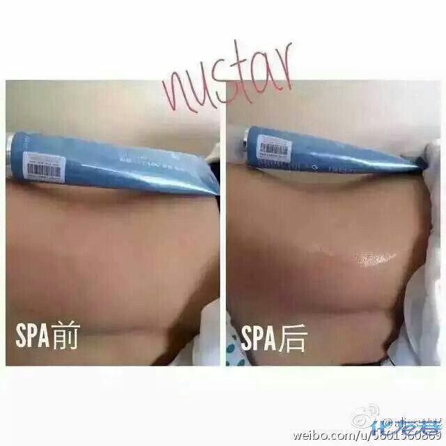 亲们,谁打过瘦肌肉型小腿的肉毒素的?从小小腿很粗,裙子短裤都不敢穿!
