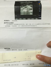 脖子上长了肿块!求解,有没有这方面的专家啊!我