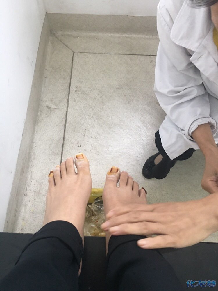 得了灰指甲一个传染俩,正在积极接受治疗,和大