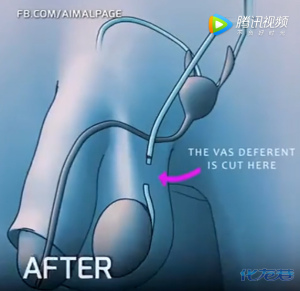 男性结扎手术原来是这么做的,学姿势了!看上去很痛的样子啊!