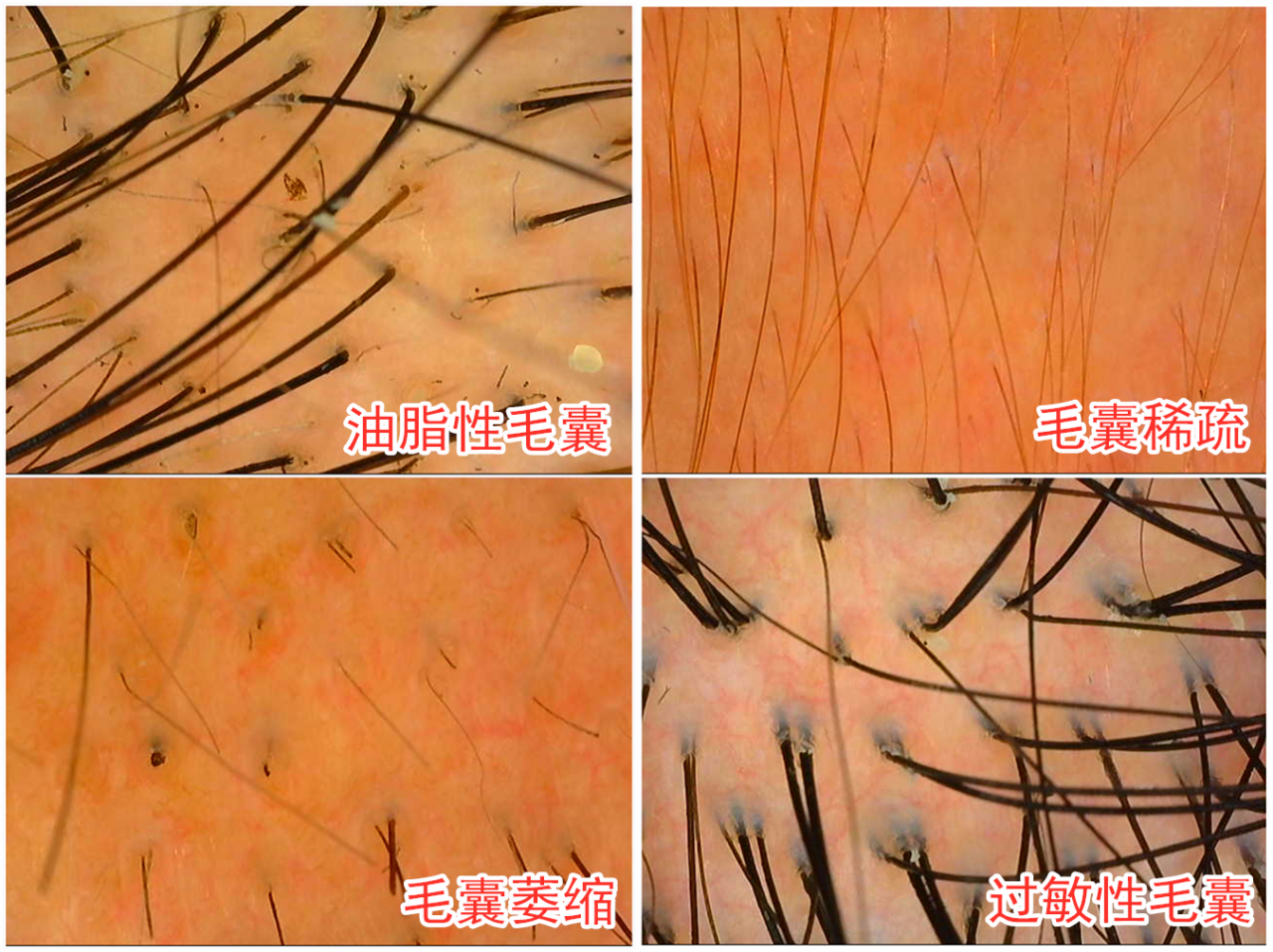 毛囊检测可以进行脱发类型,头发密度,毛囊健康