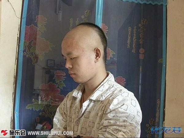 父亲早逝,母亲残疾,目前已到治疗我脑瘤的最佳