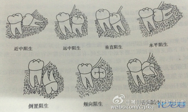 传说中的智齿,看看你有没有智齿,正常人一般是32颗牙齿4颗智齿哦