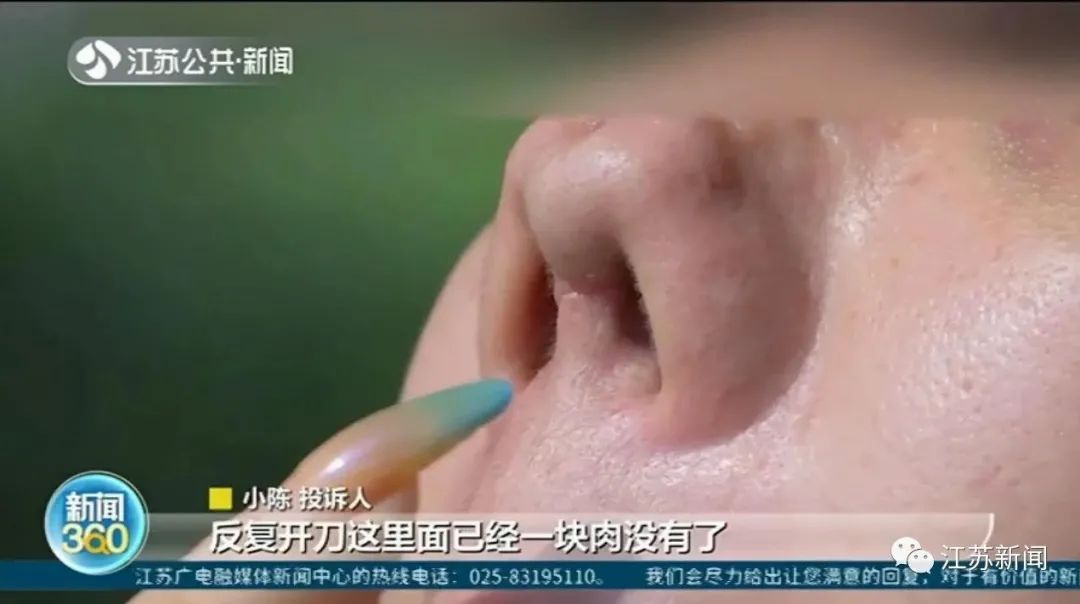 广东女主播花2万多做"隆鼻修复",鼻子变4个洞!讨说法还被暴打?