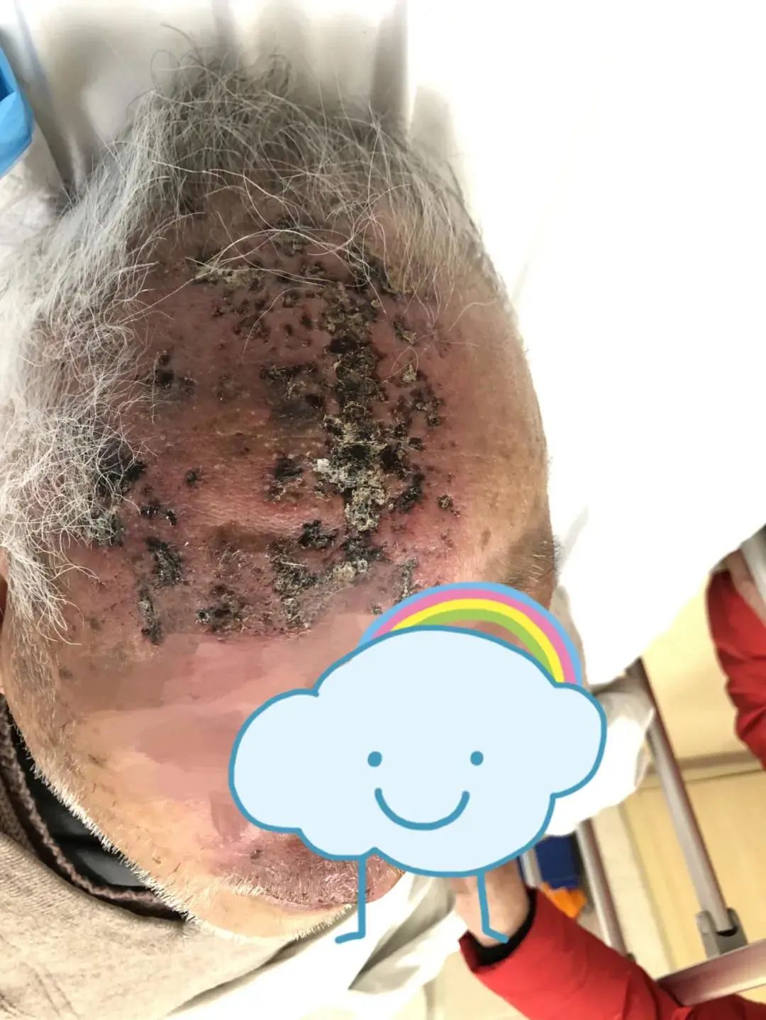 八旬大爷脸上长了几个"疱疹,结果说话颠三倒四,情况严重
