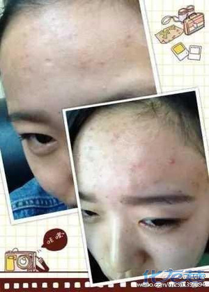 怎样才能不长青春痘 2706_934002_94576d4f04df3822.s.300x0.jpg