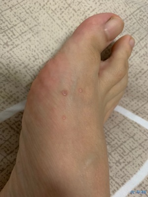 脚背侧面长了一些小疙瘩不红不肿不痒有人知道这是啥呢