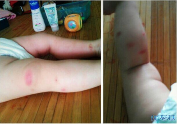 求鉴定!这到底是什么虫子啊,太可怕了孩子身上变成赤豆冰了都