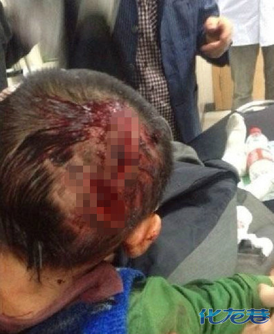 6岁男孩无故被砍 皮开肉绽 慎入!(图)