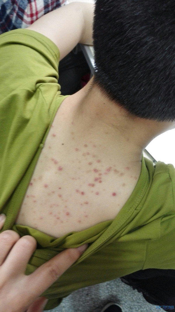 六年级小朋友,脸上身上出了很多痘痘,请问这是什么?有没好办法医治?