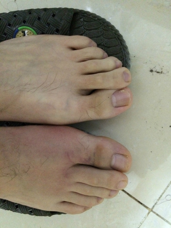 本人右脚大拇指关节囊损伤 ,肿成这个吊样,见图: 已经快3个月