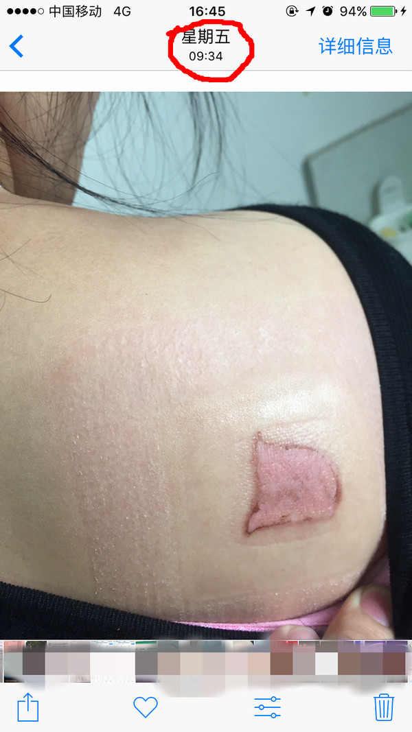 拔罐被烫伤,无良商家态度恶劣,耍赖并拒不承认责任!