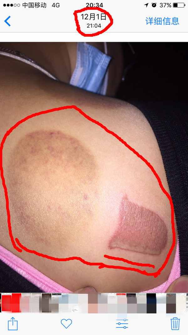 拔罐被烫伤,无良商家态度恶劣,耍赖并拒不承认责任!